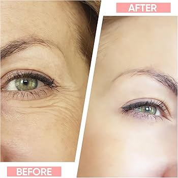 Seluna™ Face Lift Device